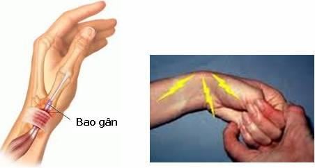 viêm bao gân