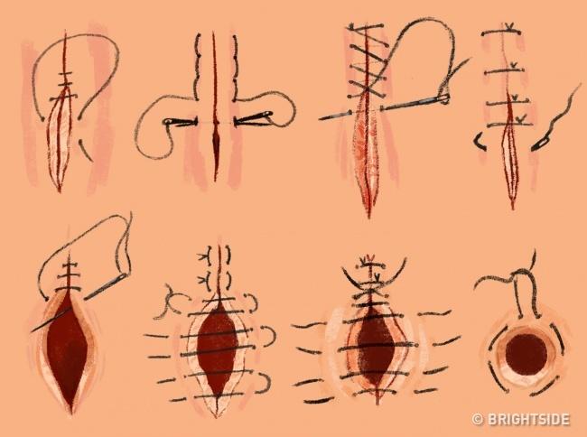 Khâu tất cả các loại vết thương: kỹ năng sinh tồn cực kỳ quan trọng