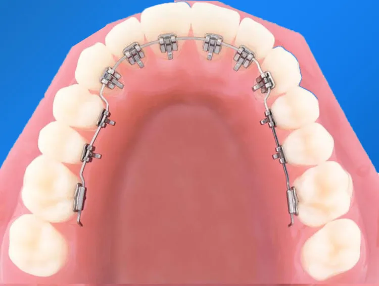 Niềng răng mặt lưỡi