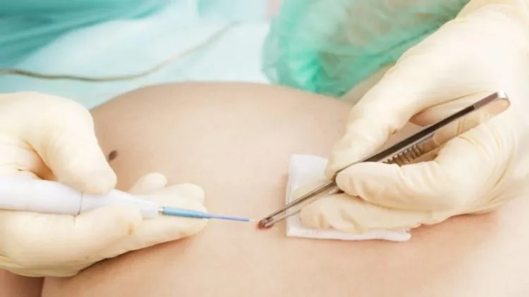 Điều trị tình trạng nốt ruồi bị ngứa