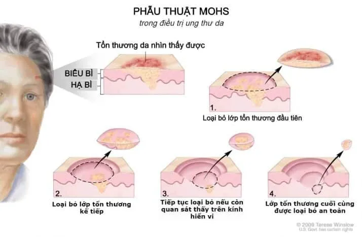 điều trị ung thư da bằng phương pháp phẫu thuật mohs