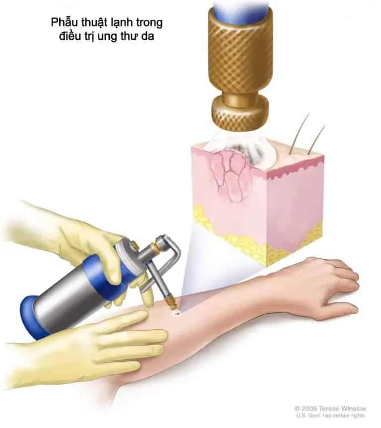 điều trị ung thư da