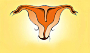 Tử cung có vách ngăn