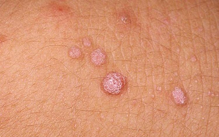 Hình ảnh mụn cóc sinh dục