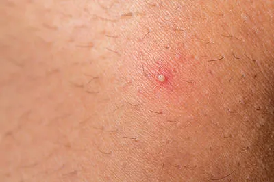 làm đẹp bằng giấm táo: làm dịu vùng da có lông mọc ngược