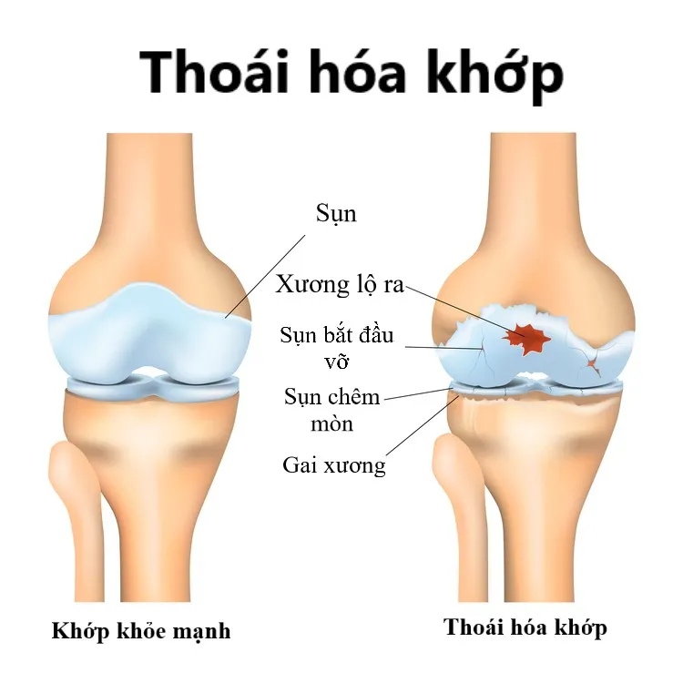 các biến chứng do thoái hóa khớp
