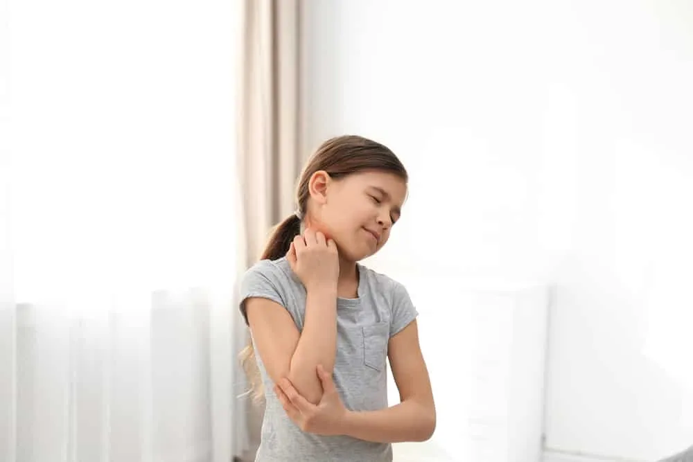 Ngứa là biểu hiện của sốc phản vệ do dị ứng với sữa