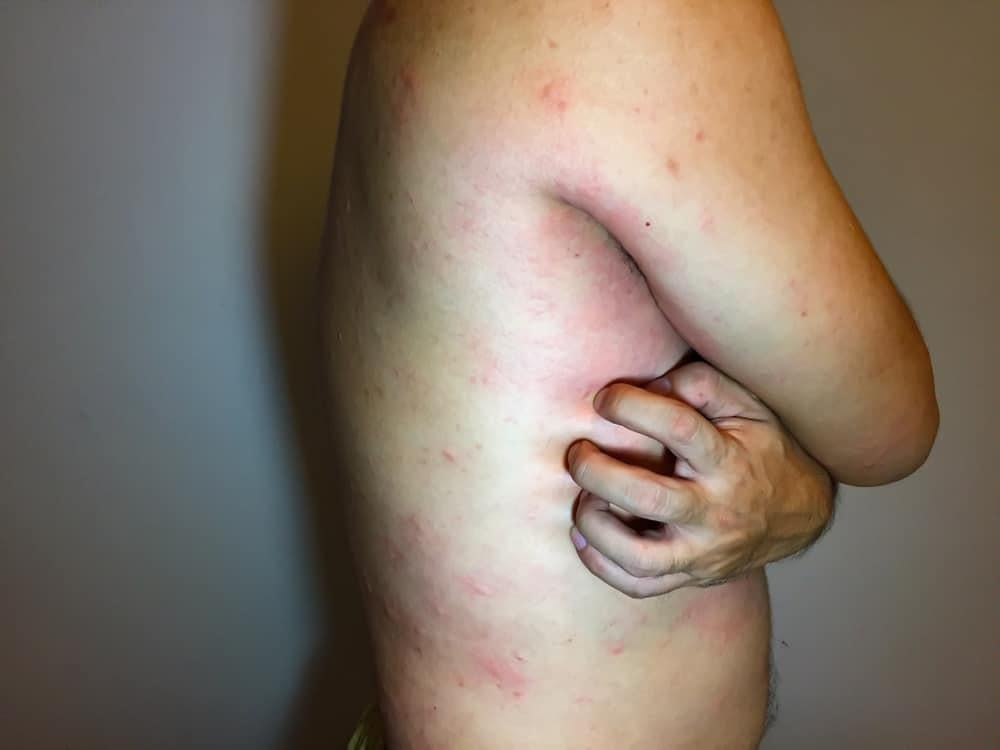 triệu chứng bệnh lupus