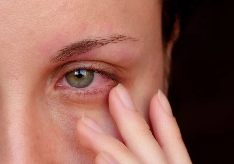 ciprofloxacin điều trị viêm kết mạc