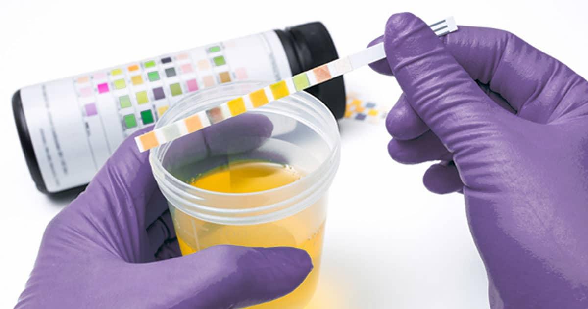 Nguyên nhân gây màu sắc nước tiểu bất thường