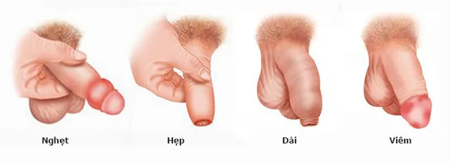 hình ảnh minh họa bao quy đầu