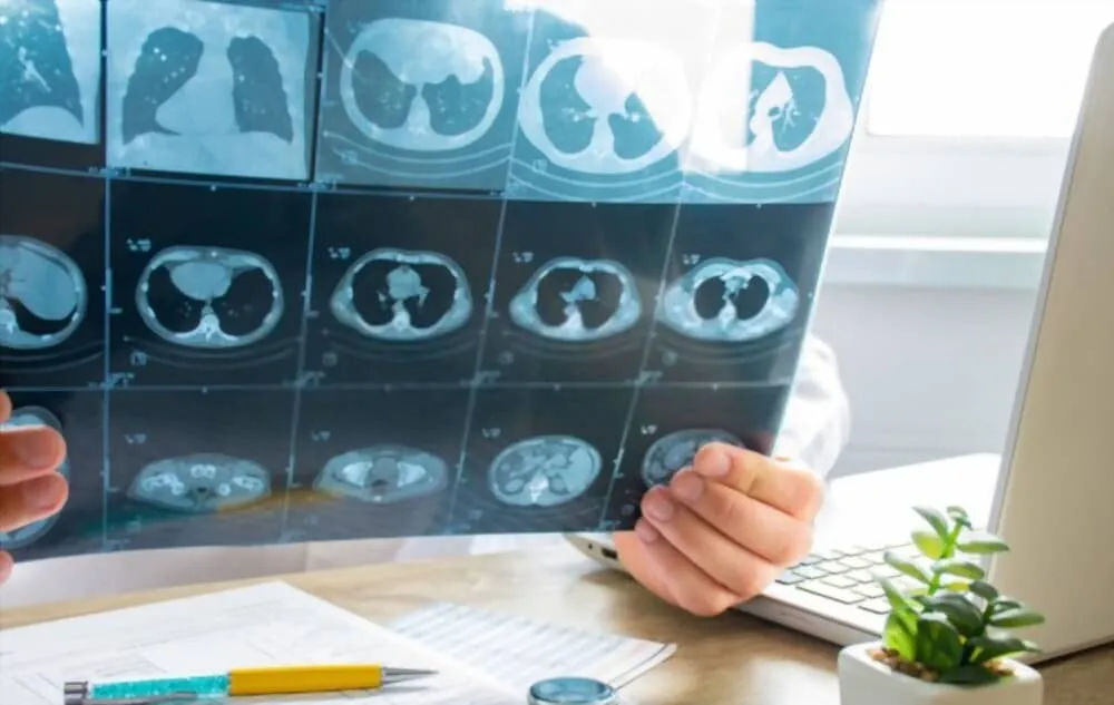 chẩn đoán bệnh phù phổi