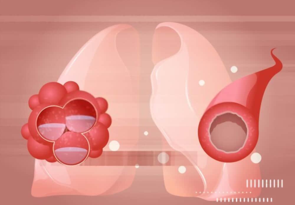 nguyên nhân gây phù phổi