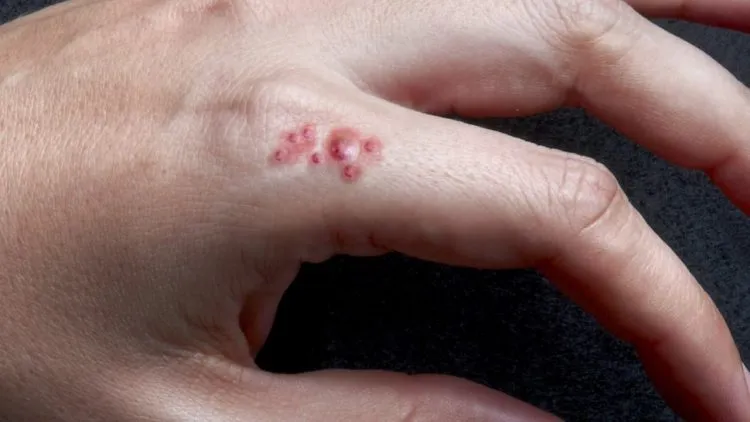 triệu chứng nhiễm trùng da