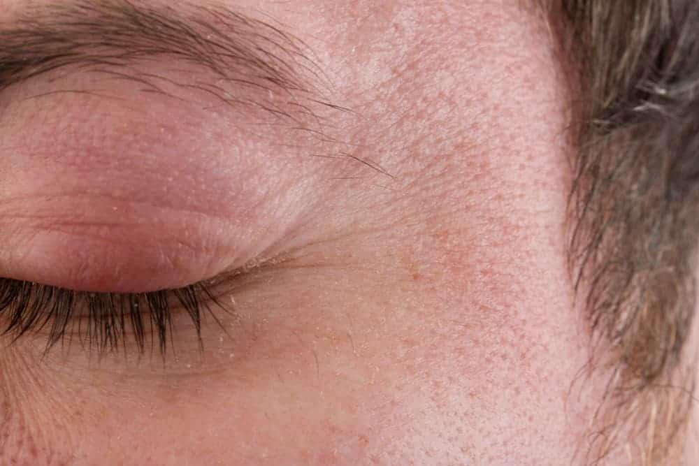 dấu hiệu đau mắt hột