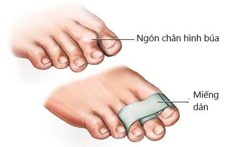 điều trị ngón chân hình búa