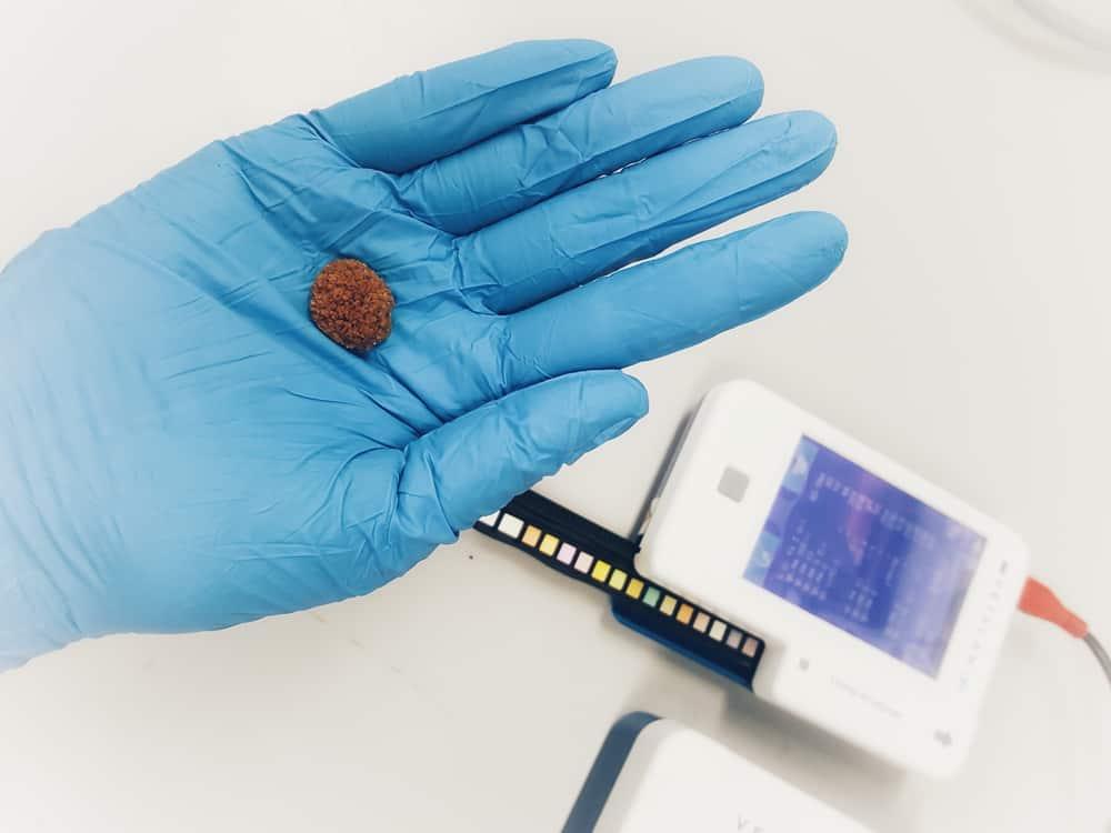 Lấy sỏi tiết niệu giải quyết cơn đau quặn thận