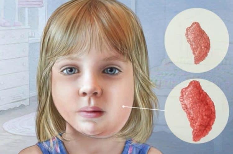 Triệu chứng bệnh quai bị ở trẻ em