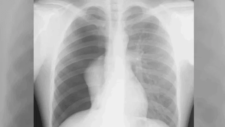 triệu chứng khó thở hụt hơi