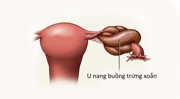 Dấu hiệu u nang buồng trứng: U nang buồng trứng xoắn