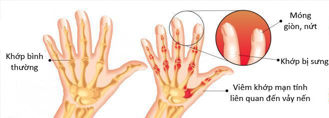 bệnh viêm khớp vảy nến