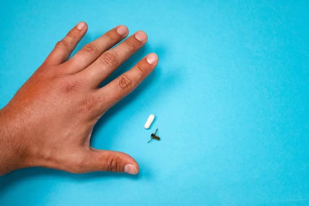 Triệu chứng dị ứng côn trùng đốt cắn