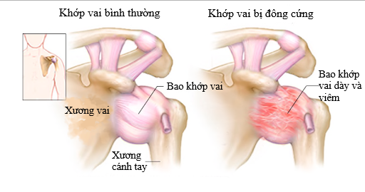 hình ảnh đông cứng vai