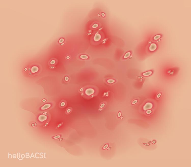 bệnh vảy nến thể mủ