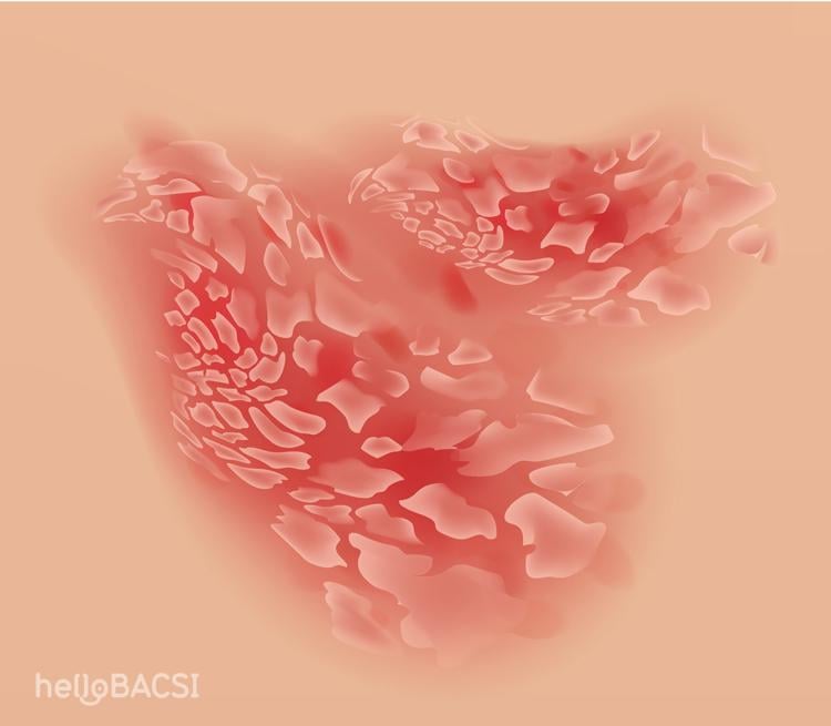 Bệnh vảy nến toàn thân