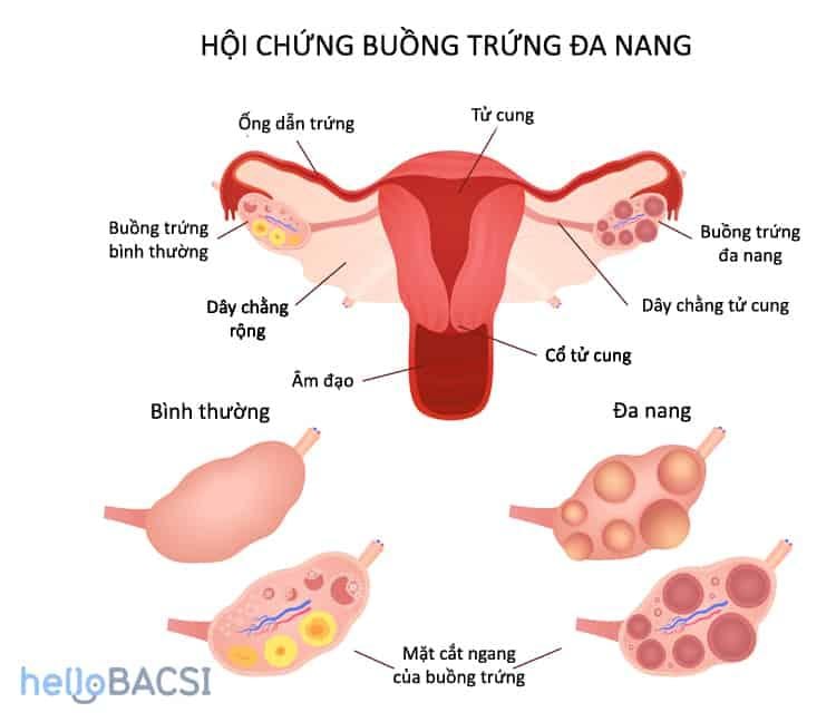 Nguyên nhân dẫn đến hội chứng buồng trứng đa nang