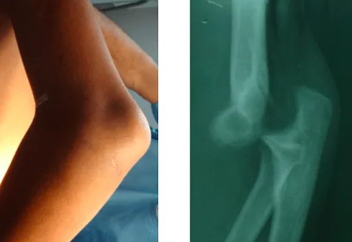 Đau khuỷu tay do trật xương khớp