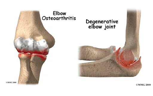 Viêm khuỷu tay do thoái hóa khớp