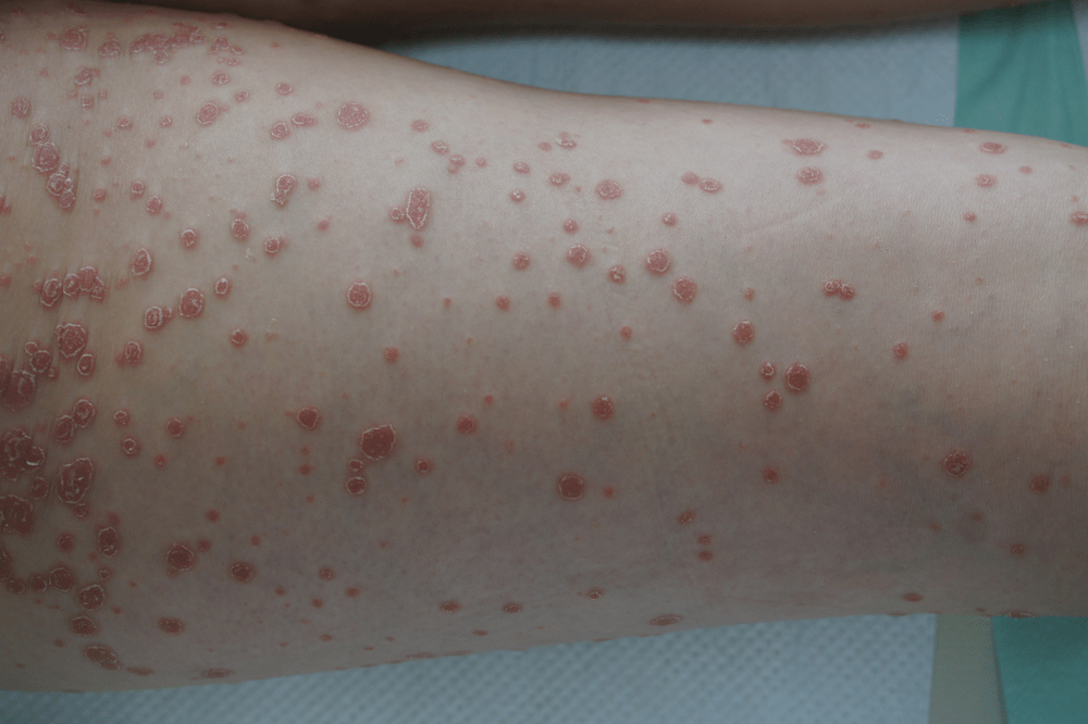 vảy nên thể giọt