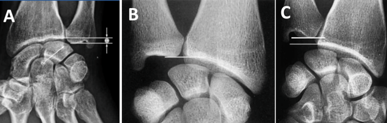 nguyên nhân gây đau cổ tay bên trụ