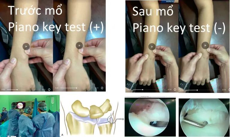 đau cổ tay bên trụ