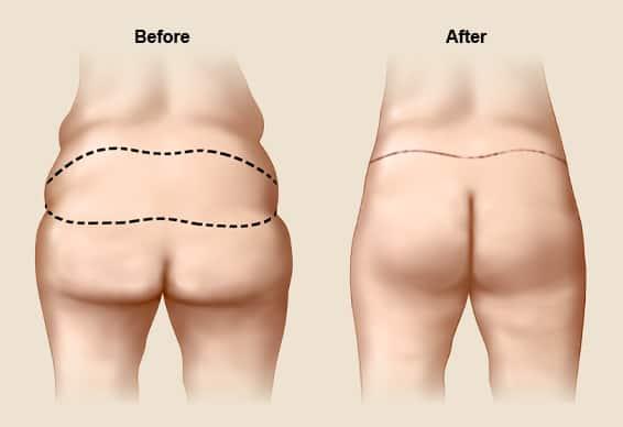 phẫu thuật nâng mông