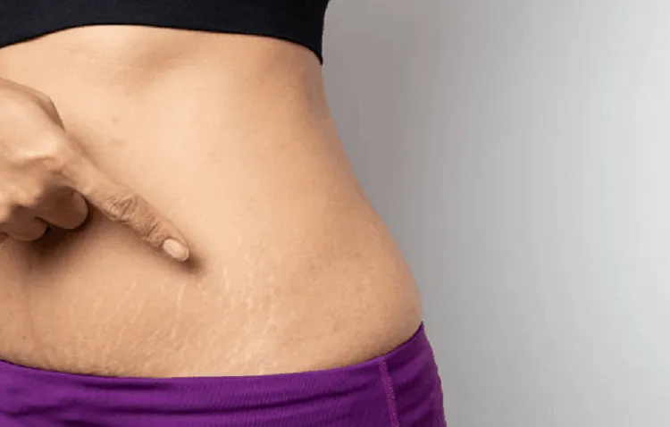 trị rạn da bằng dầu ô liu