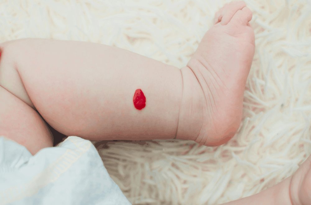 u máu ở trẻ sơ sinh