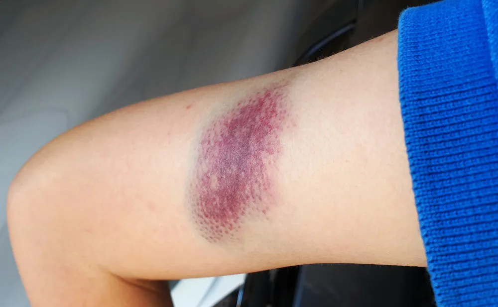 dễ bị bầm tím là dấu hiệu cảnh báo bệnh liên quan đến gan