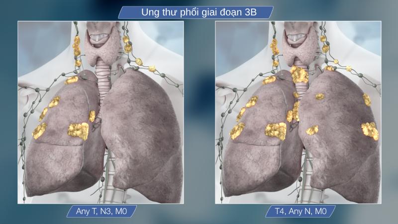 ung thư phổi giai đoạn 3B