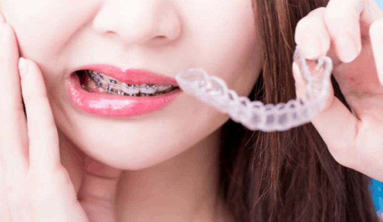 răng mọc lệch gây chảy máu chân răng