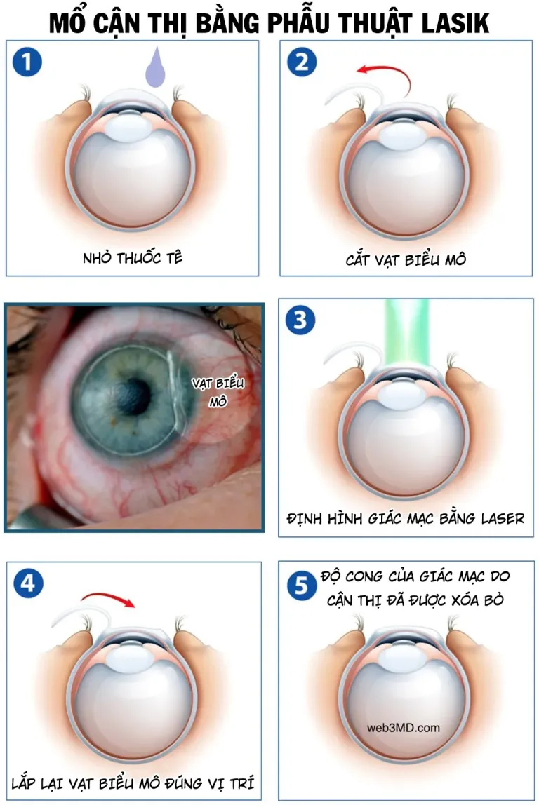 Mổ cận thị bằng phẫu thuật LASIK