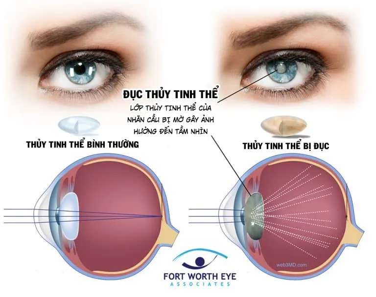 Mổ đục thủy tinh thể 1