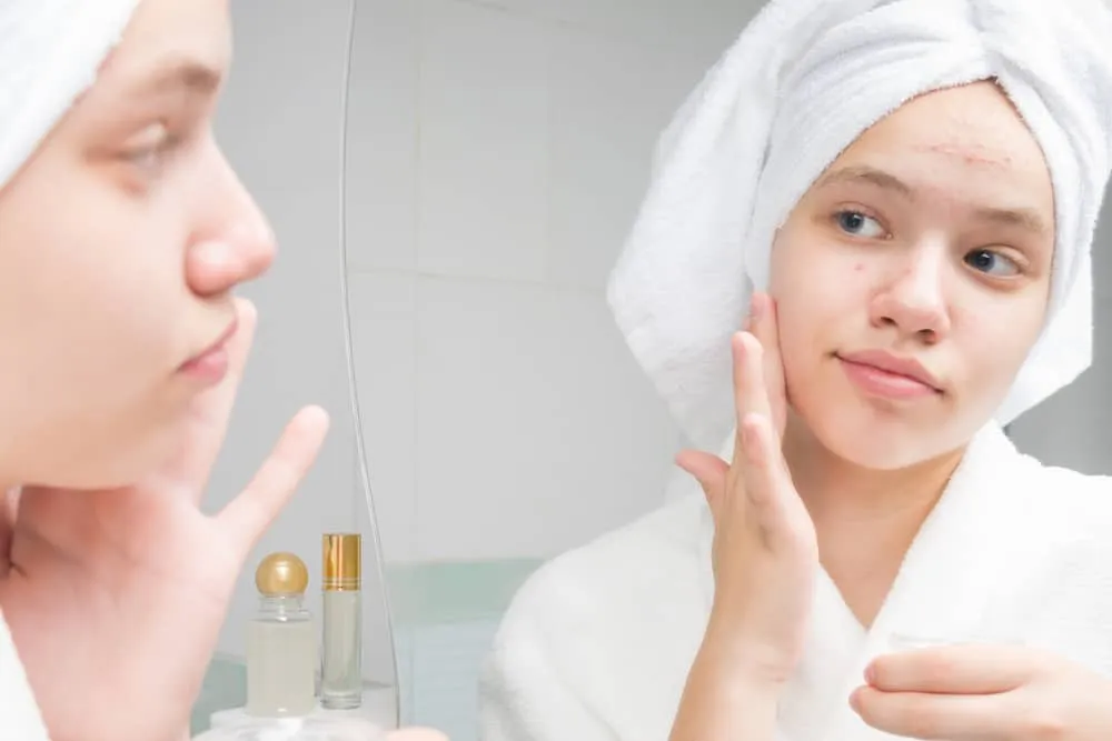 Gây nổi mụn là tác hại của trà sữa