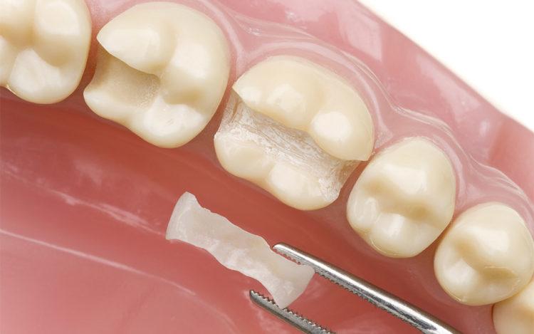 quy trình trám răng gián tiếp