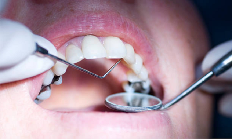 quy trình trám răng trực tiếp