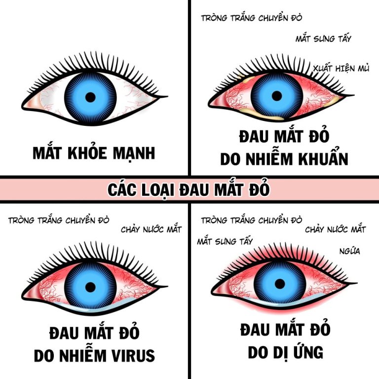 Triệu chứng đau mắt đỏ 1