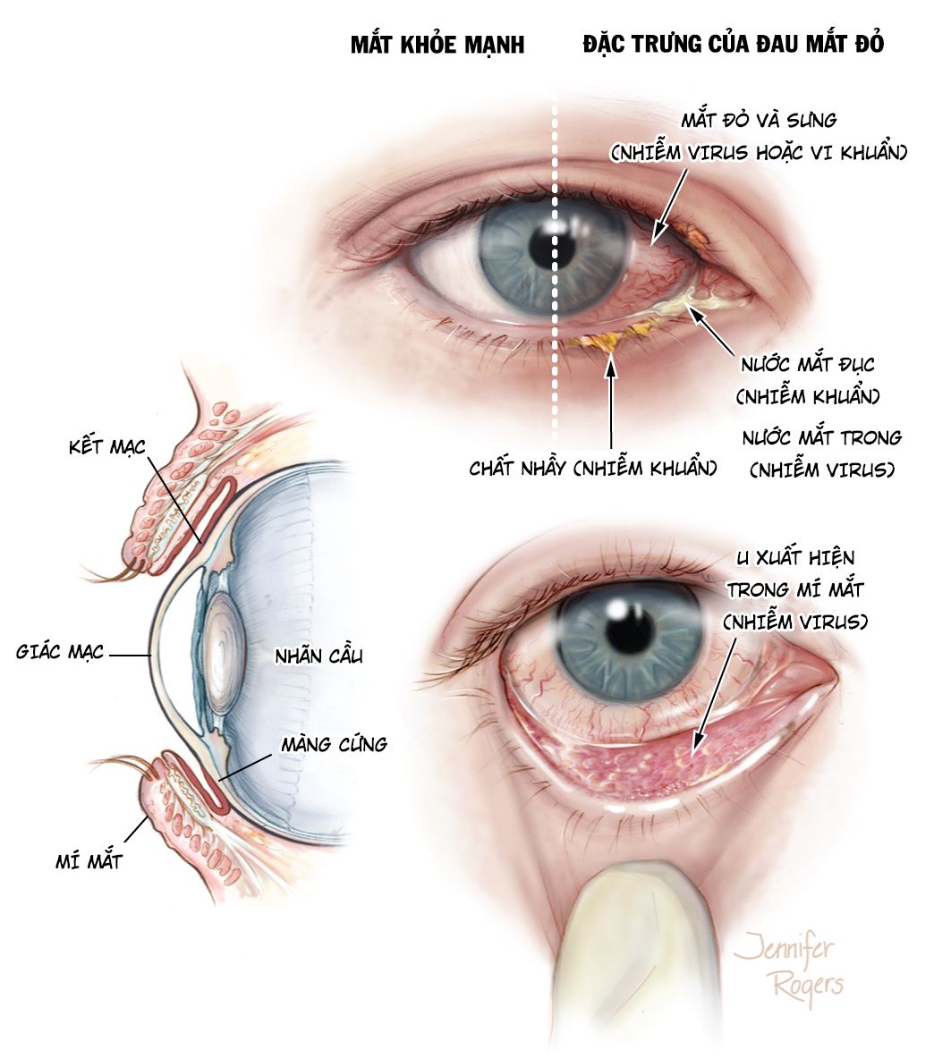 Viêm kết mạc mắt