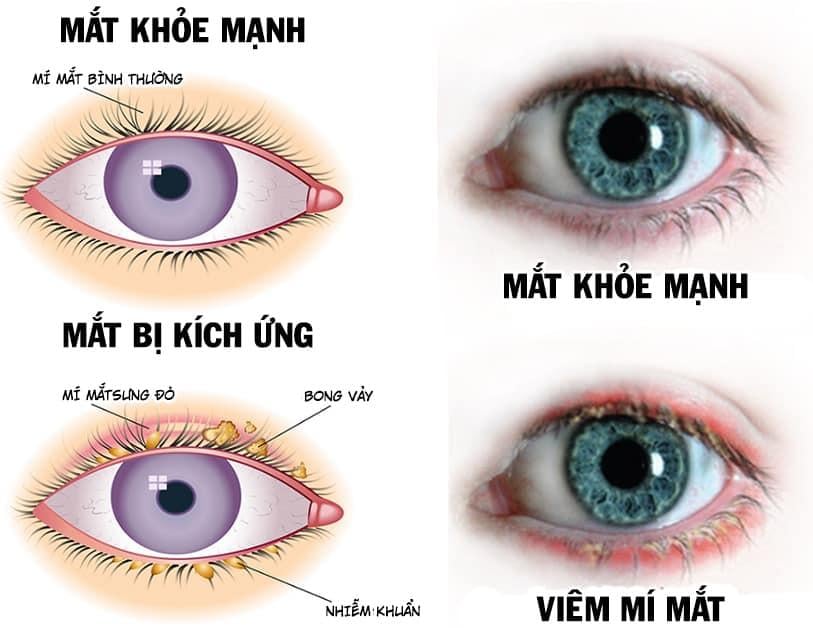 Có 2 loại viêm mí mắt phổ biến là viêm mí mắt ngoài và viêm mí mắt trong