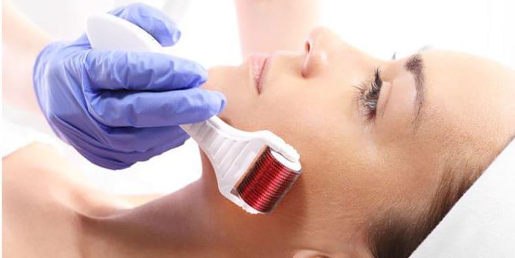 Cách trị thâm đỏ sau mụn bằng lăn kim